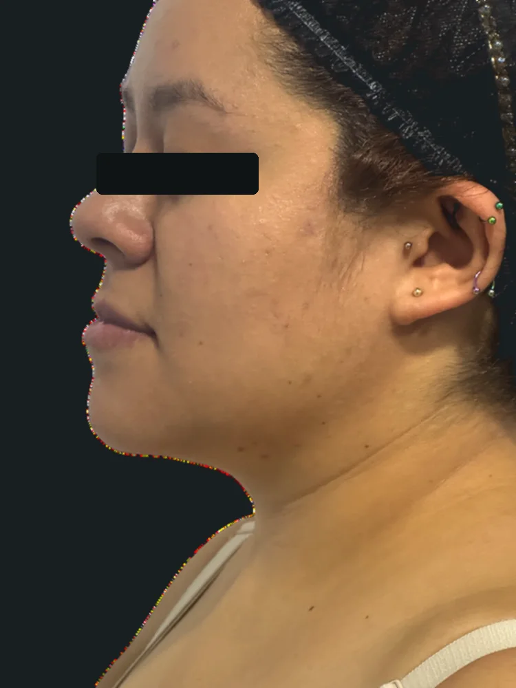 Antes: perfil facial con papada