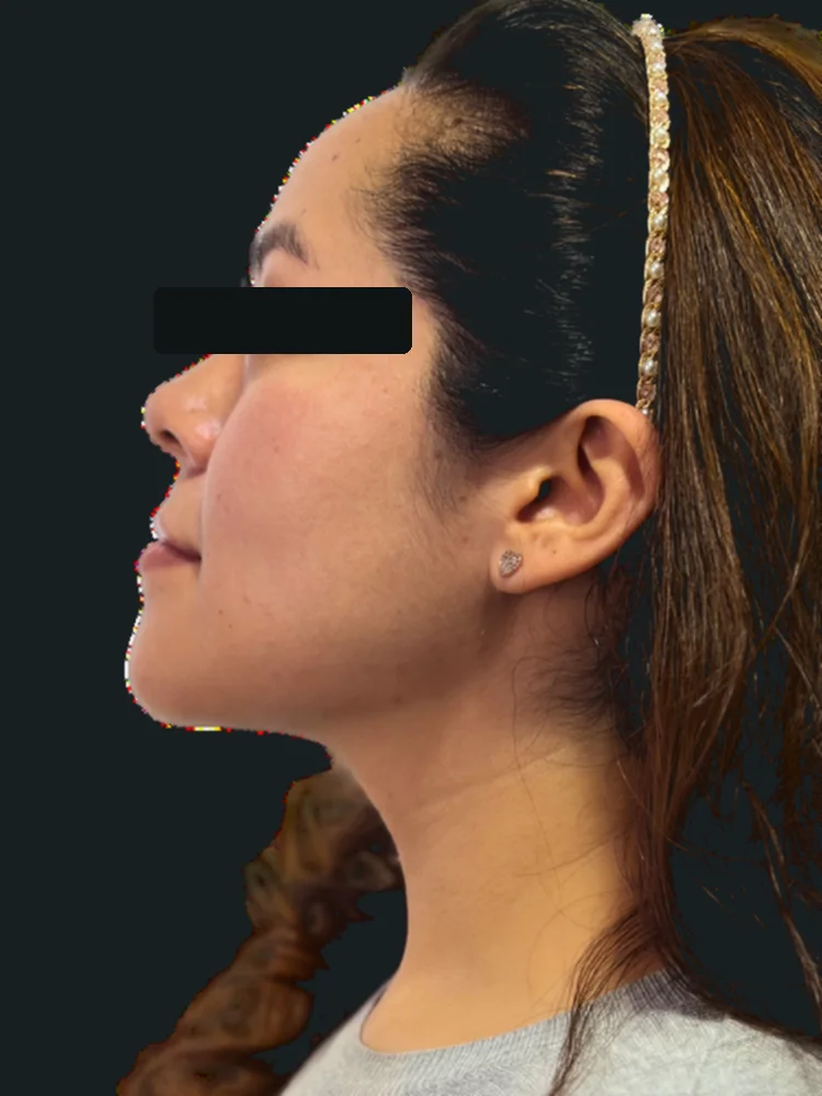 Después: perfil facial definido tras tratamiento con el Dr. Andrés Andrade